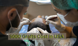 5000 graft hair transplant cost in the USA-UK [In 2024]