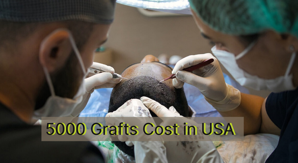 Read more about the article 5000 graft hair transplant cost in the USA-UK [In 2024]