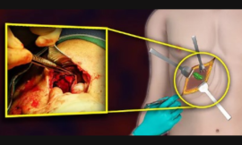 How will a contracted gallbladder discomfit you? (Update of 2024)