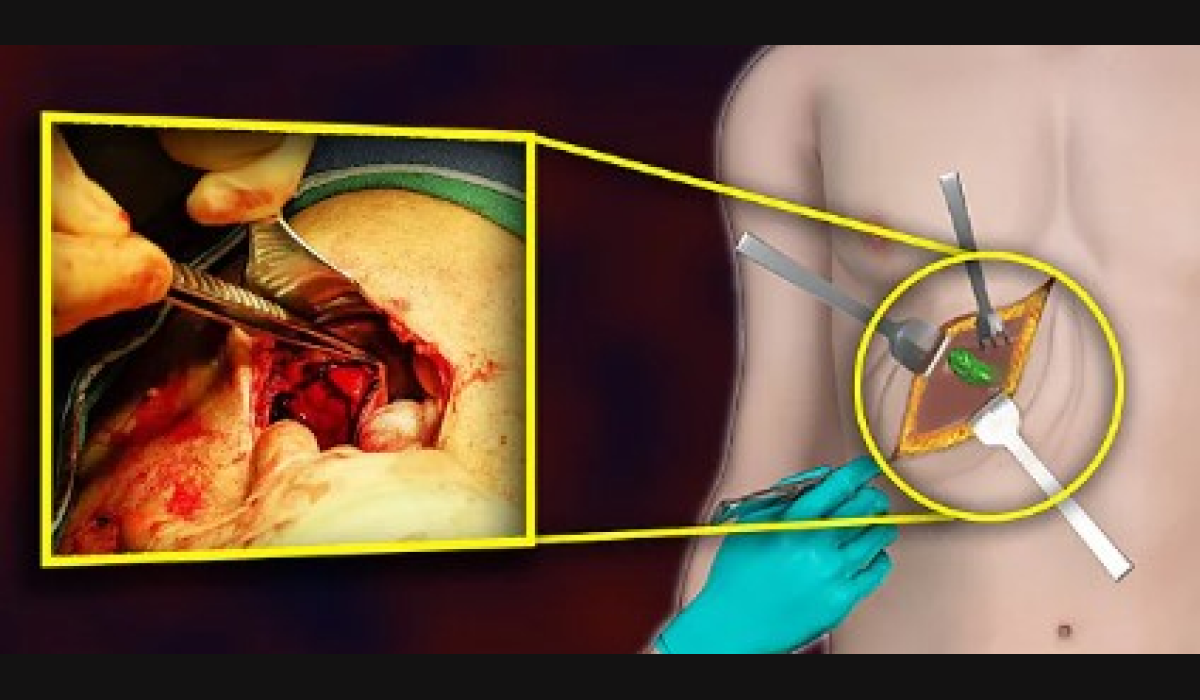 contracted gallbladder