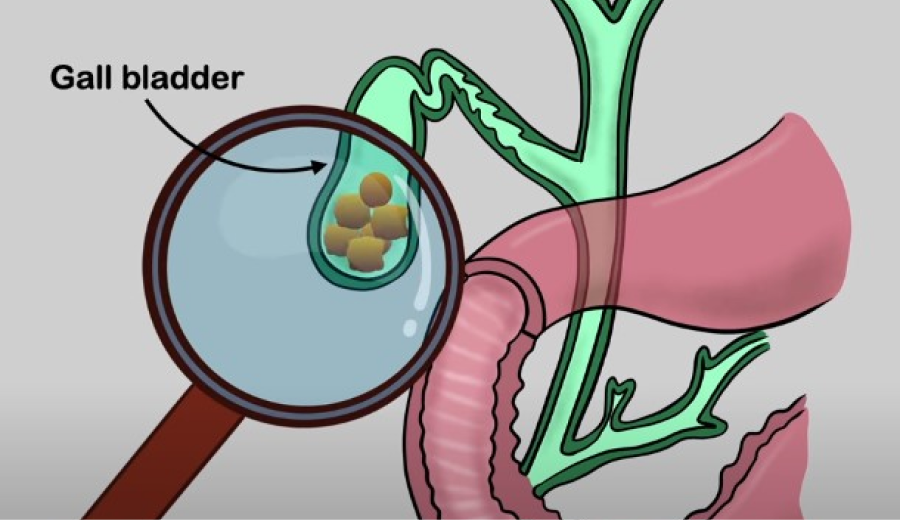 contracted gallbladder causes