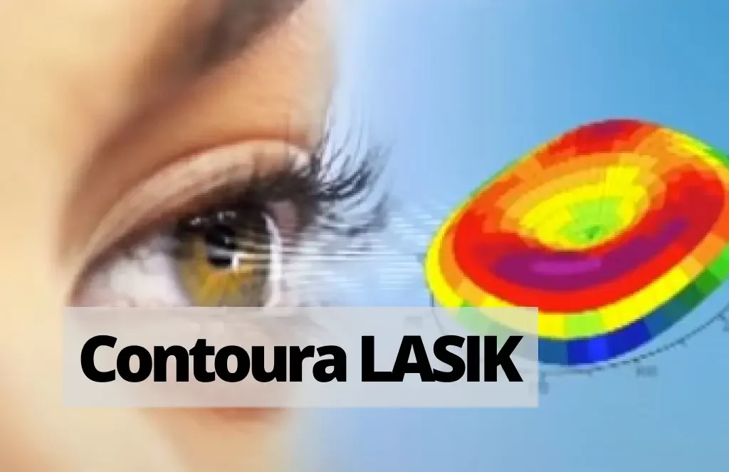 Read more about the article Explain Contoura LASIK: A Topography Guided Surgery [2024]