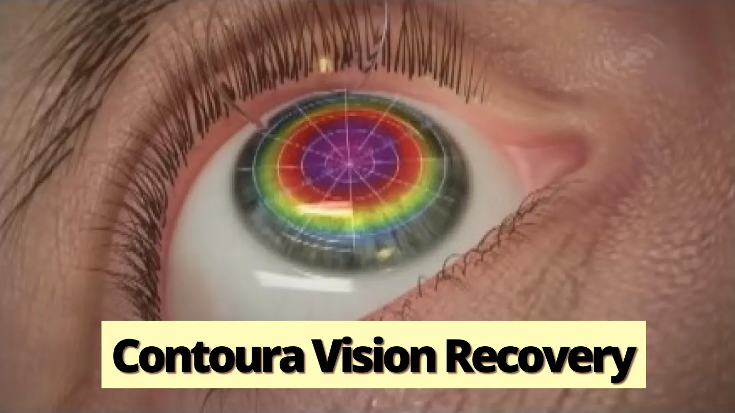 Contoura LASIK Topography guided surgery 1