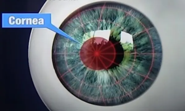 Alternatives of LASIK