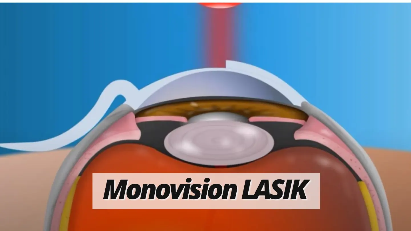 Monovision LASIK