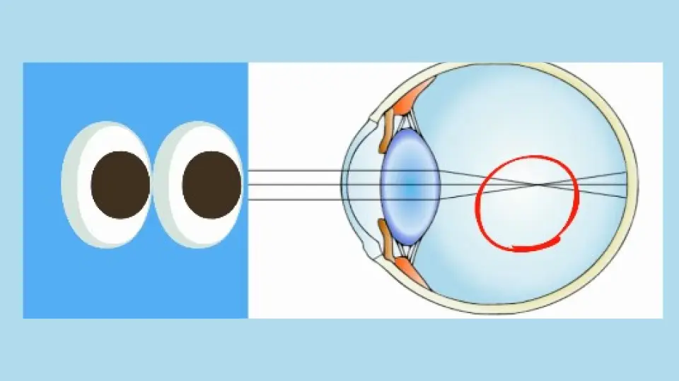 How Nearsighted persons retina recieve light